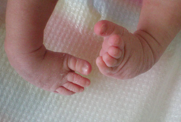 آمار نگران کننده یک بیماری مادرزادی در کهگیلویه و بویراحمد